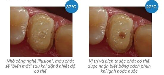Chốt sợi thủy tinh Macro-Lock Post Illusion X-RO 1