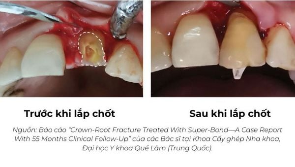 MatchPost Fiber Post - Chốt sợi thủy tinh - lâm sàng