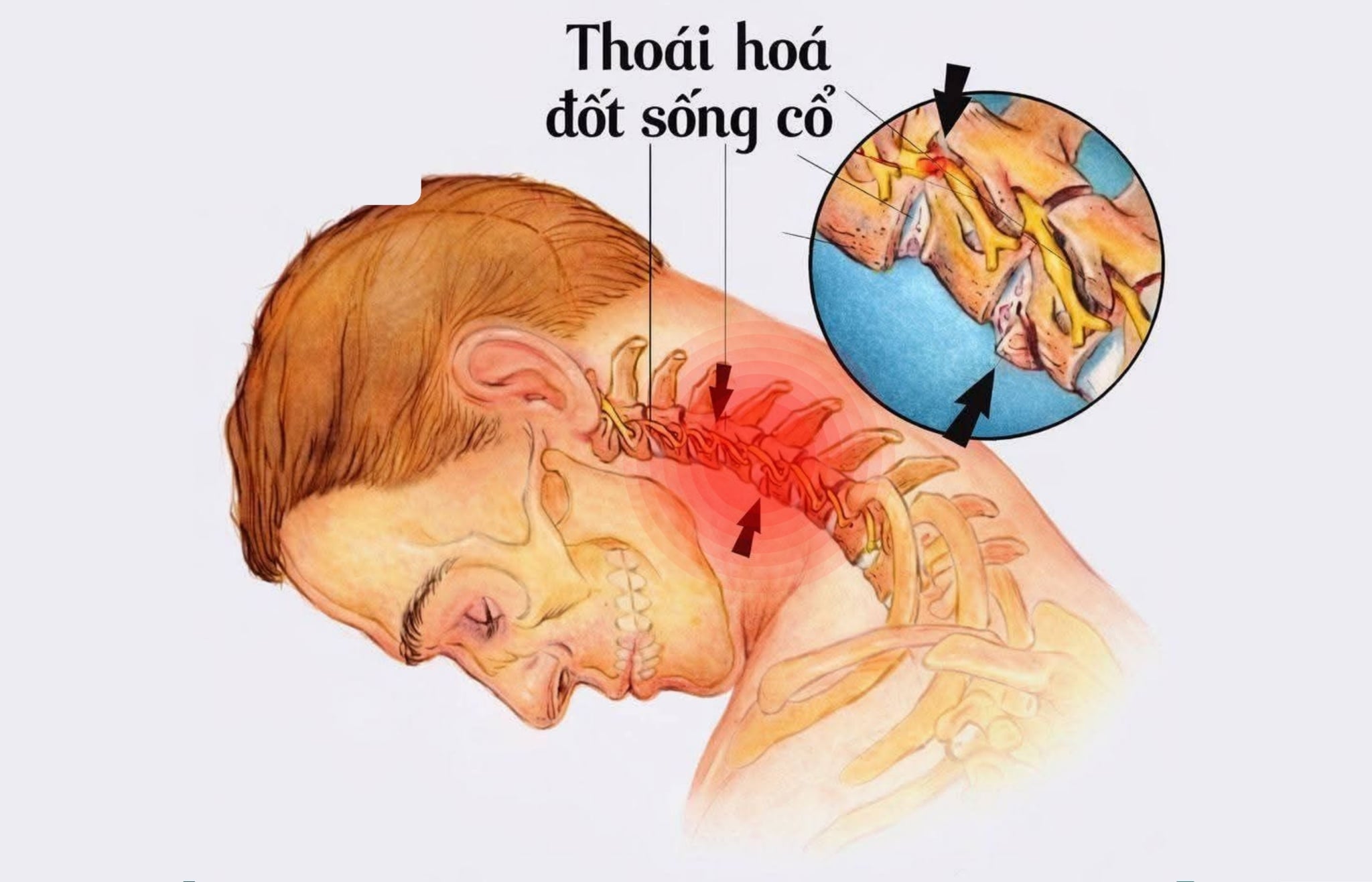 ĐAU CỔ VAI GÁY: NGUYÊN NHÂN, BIỂU HIỆN VÀ 5 CÁCH CẢI THIỆN TẠI NHÀ
