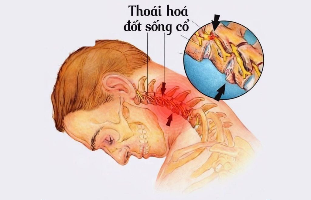 ĐAU CỔ VAI GÁY: NGUYÊN NHÂN, BIỂU HIỆN VÀ 5 CÁCH CẢI THIỆN TẠI NHÀ