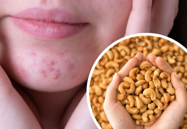 Tại sao nhiều người lo ăn hạt điều tẩm vị sẽ bị mụn?