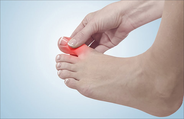 bệnh gout có ăn hạt điều được không