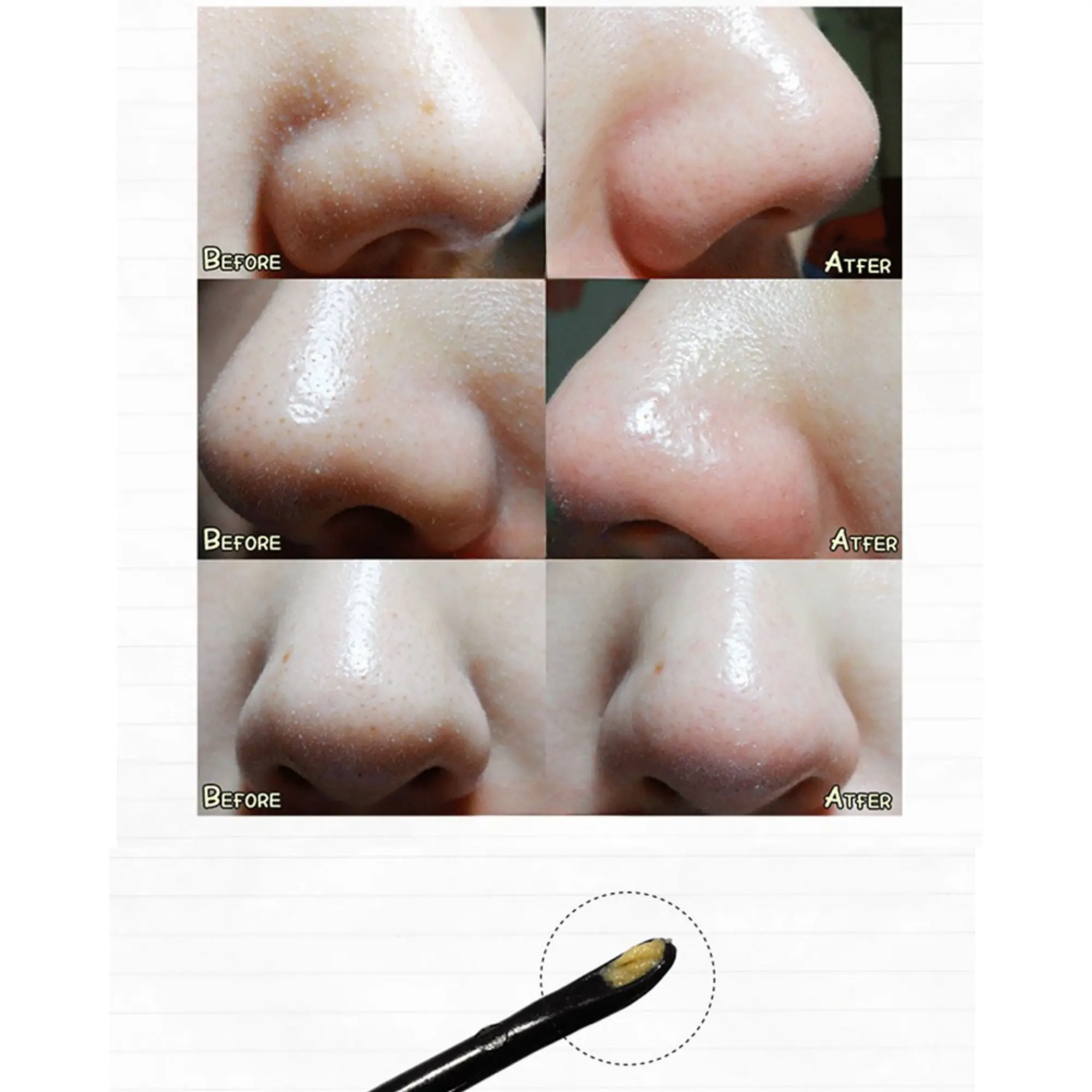 miếng đẩy mụn