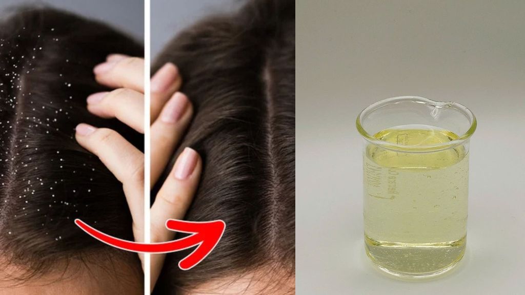 Piroctone Olamine: “Vệ sĩ thầm lặng” giảm gàu không cần “hành hạ” da đầu – sạch gàu không silicone