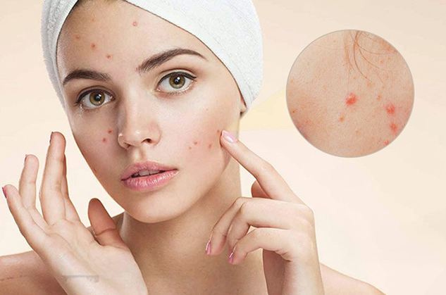 🧪Bùng nổ concept Anti-Acnes đa tầng: DA MỤN – NHẠY CẢM ĐANG BỊ TỔN THƯƠNG THẦM LẶNG MỖI NGÀY🧪