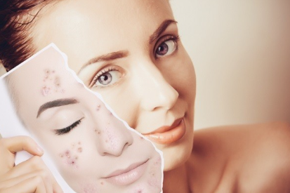 🧪Bùng nổ concept Anti-Acnes đa tầng: Sulfur 6.7% + LHA  + QS Control AC – “Trái tim” của kem chấm mụn điểm thế hệ mới