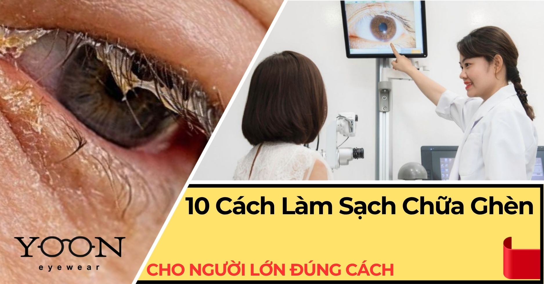 10 Cách Làm Sạch Và Chữa Ghèn Mắt Cho Người Lớn Đúng Cách