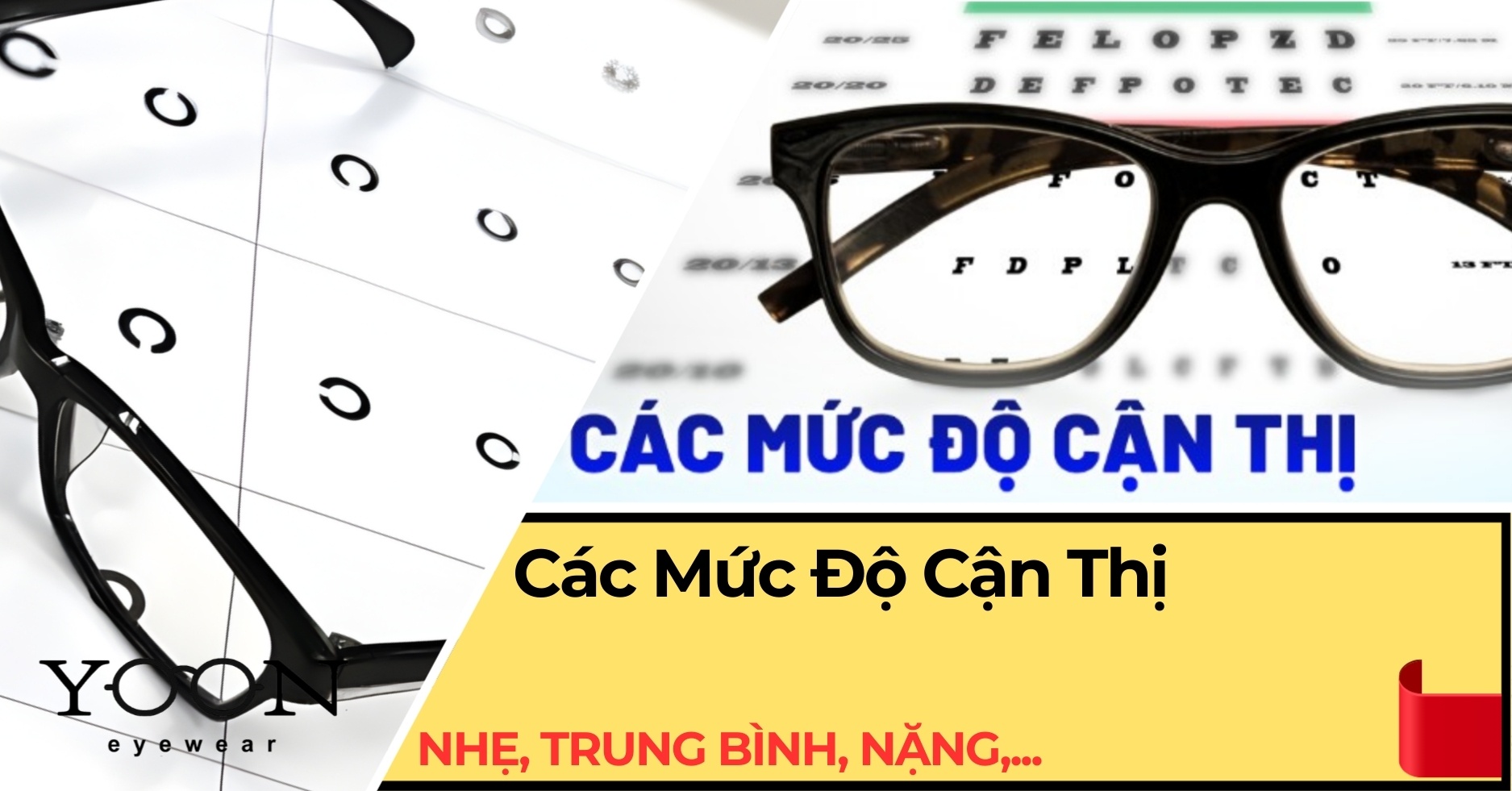 Các Mức Độ Cận Thị: Nhẹ, Trung Bình, Nặng & Cách Nhận Biết