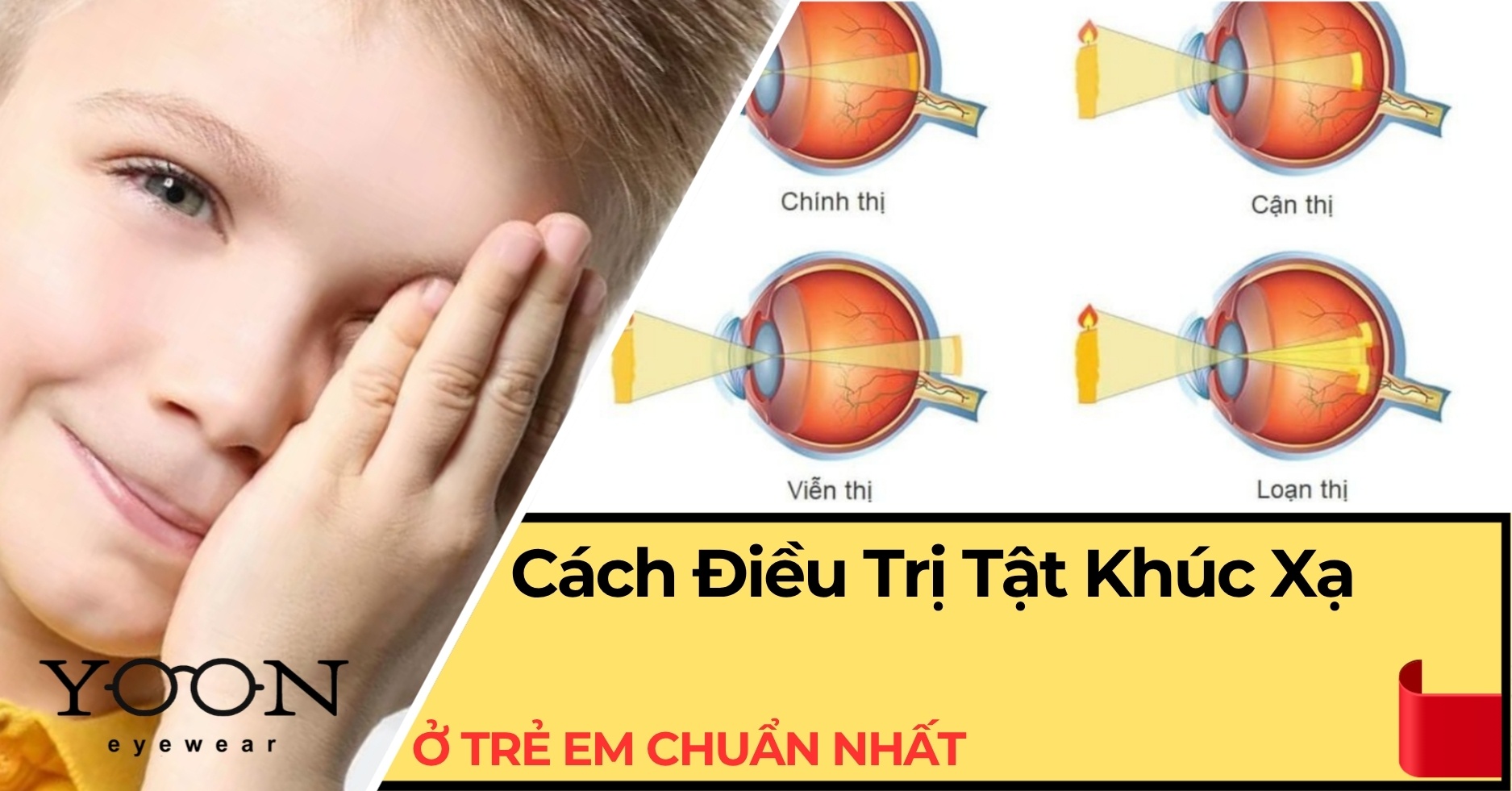 Cách Điều Trị Tật Khúc Xạ Ở Trẻ Em Chuẩn Nhất