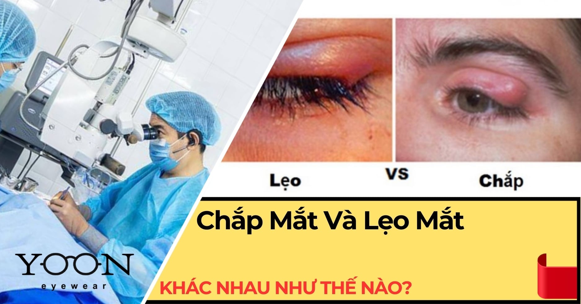 Chắp Mắt Và Lẹo Mắt Khác Nhau Như Thế Nào?
