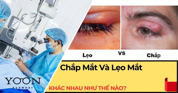 Chắp Mắt Và Lẹo Mắt Khác Nhau Như Thế Nào?