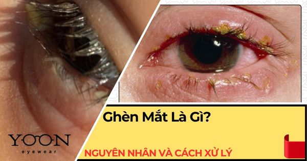 Ghèn Mắt Là Gì? Nguyên Nhân Và Cách Xử Lý Hiệu Quả