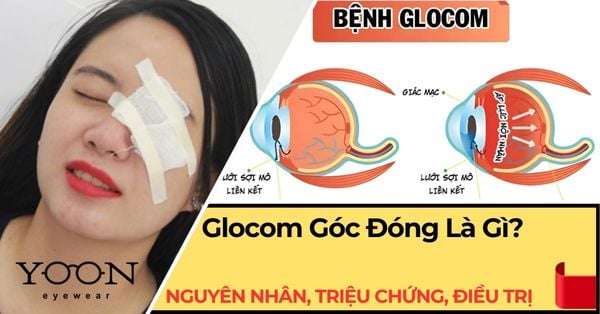 Glocom Góc Đóng Là Gì? Nguyên Nhân, Triệu Chứng & Điều Trị