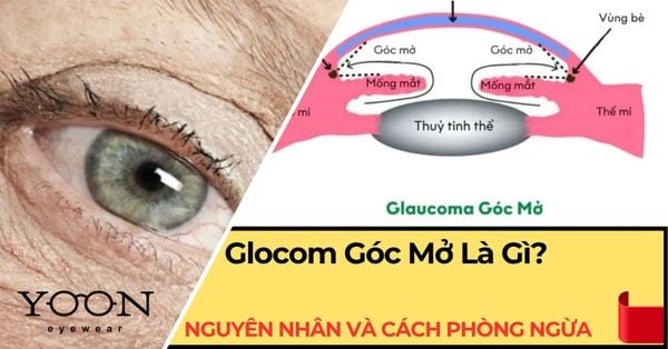 Glocom Góc Mở Là Gì? Nguyên Nhân, Dấu Hiệu & Cách Phòng Ngừa
