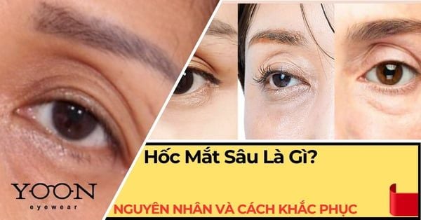 Hốc Mắt Sâu Là Gì? Nguyên Nhân, Đặc Điểm & Cách Khắc Phục