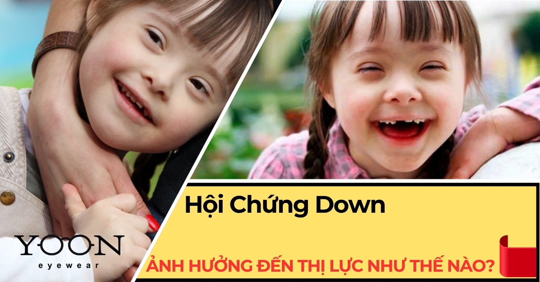 Hội Chứng Down Ảnh Hưởng Đến Thị Lực Như Thế Nào?