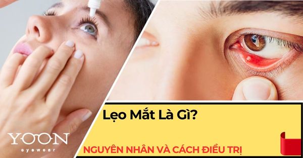 Lẹo Mắt Là Gì? Nguyên Nhân, Dấu Hiệu & Cách Điều Trị