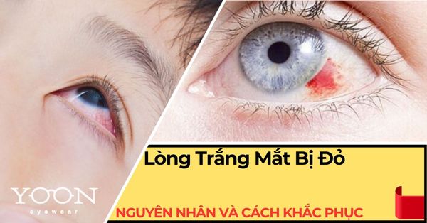 Lòng Trắng Mắt Bị Đỏ Là Do Đâu? Nguyên Nhân & Cách Khắc Phục