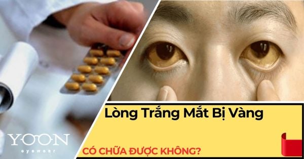 Lòng Trắng Mắt Bị Vàng Có Chữa Được Không? Hướng Dẫn Chi Tiết