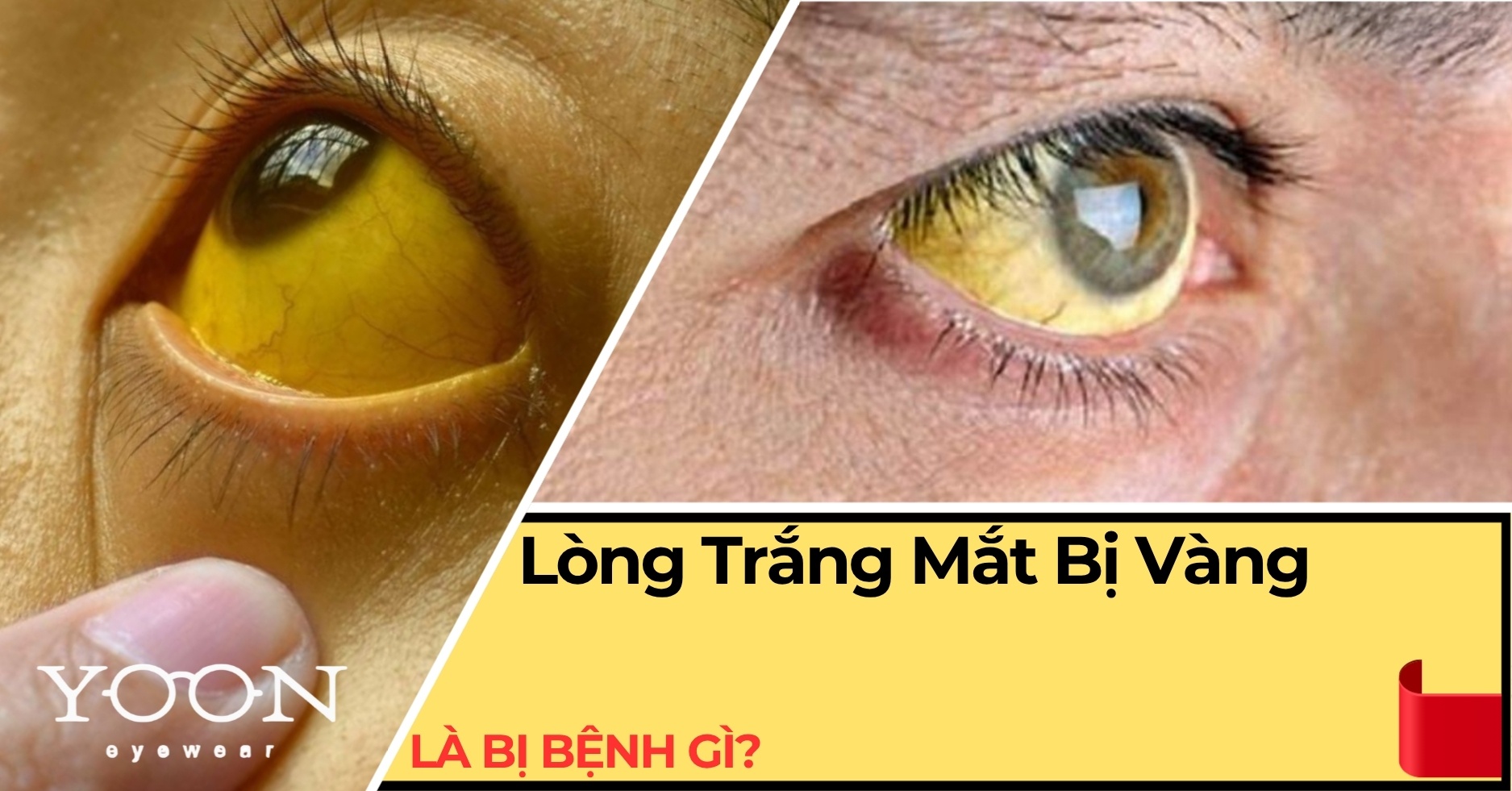 Lòng Trắng Mắt Bị Vàng Là Bệnh Gì? Khi Nào Cần Đi Khám?
