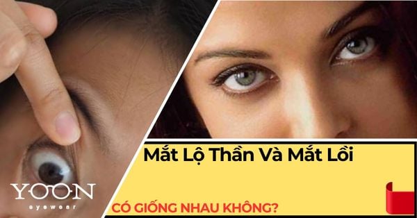 Mắt Lộ Thần Và Mắt Lồi Có Giống Nhau Không? Giải Đáp Chi Tiết