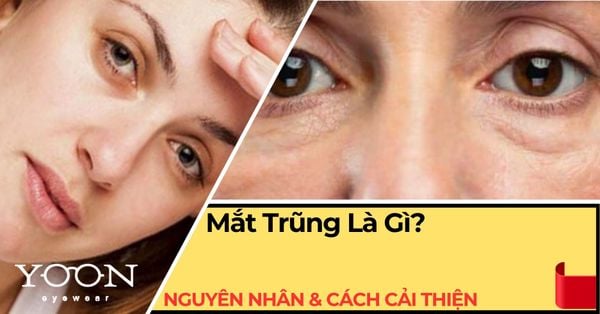 Mắt Trũng Là Gì? Nguyên Nhân, Dấu Hiệu & Cách Khắc Phục