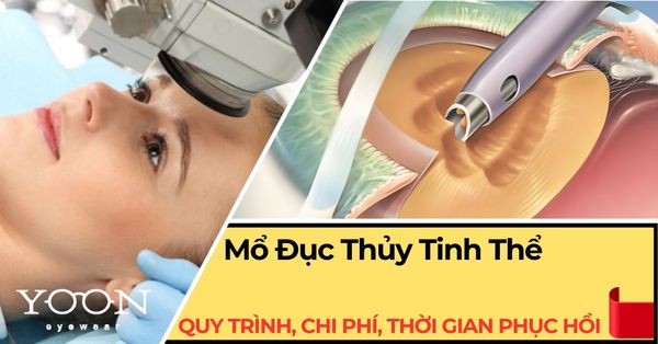 Mổ Đục Thủy Tinh Thể: Quy Trình, Chi Phí & Thời Gian Hồi Phục