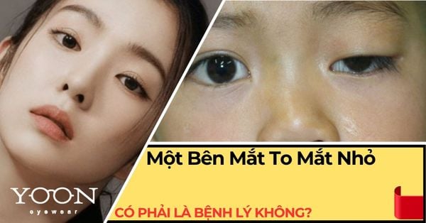 Một Bên Mắt To Một Bên Mắt Nhỏ Có Phải Bệnh Lý Không?