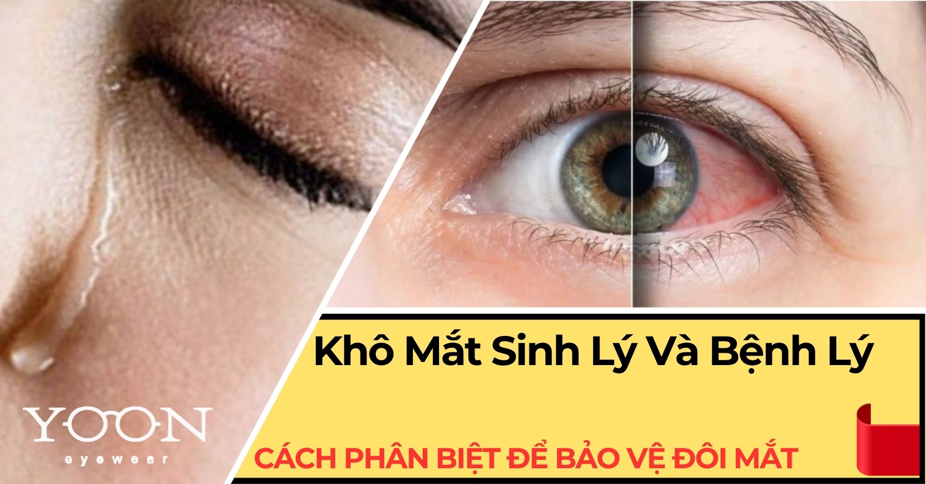 Phân Biệt Khô Mắt Sinh Lý Và Bệnh Lý – Hiểu Để Bảo Vệ Đôi Mắt