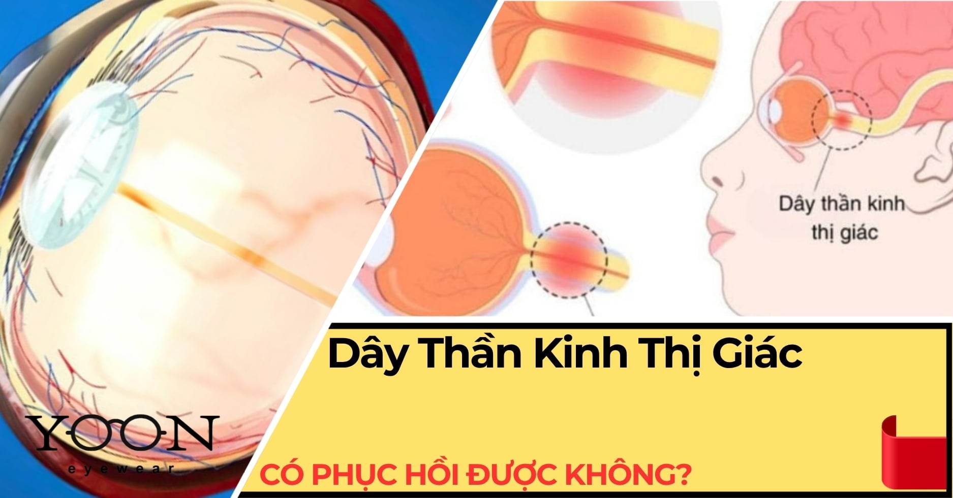 Phục Hồi Dây Thần Kinh Thị Giác: Có Khả Thi Không?