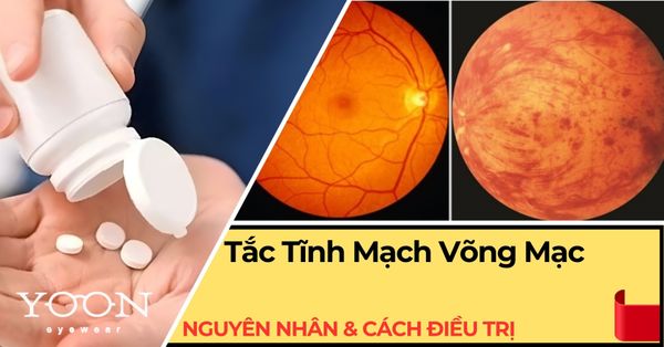 Tắc Tĩnh Mạch Trung Tâm Võng Mạc: Nguyên Nhân & Cách Điều Trị