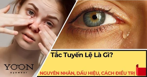 Tắc Tuyến Lệ Là Gì? Nguyên Nhân, Dấu Hiệu & Cách Điều Trị