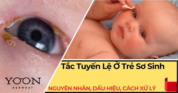 Tắc Tuyến Lệ Ở Trẻ Sơ Sinh: Nguyên Nhân, Dấu Hiệu & Cách Xử Lý