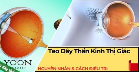 Teo Dây Thần Kinh Thị Giác Là Gì? Nguyên Nhân & Cách Điều Trị