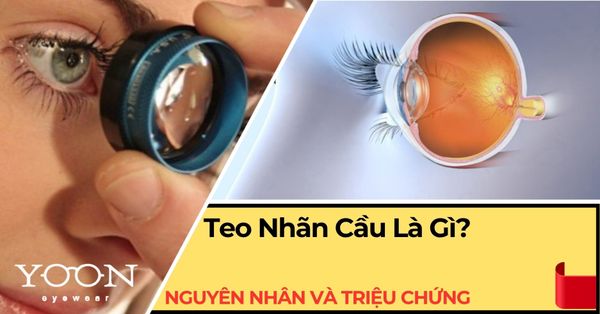 Teo Nhãn Cầu: Nguyên Nhân, Triệu Chứng & Cách Điều Trị