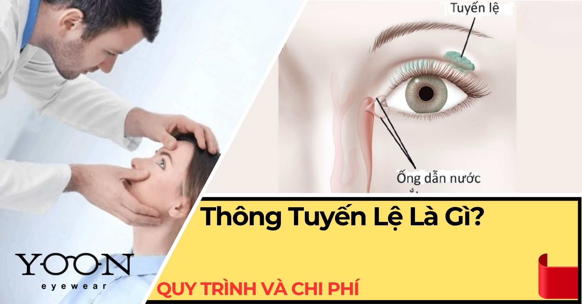 Thông Tuyến Lệ Là Gì? Quy Trình, Chi Phí & Những Điều Cần Biết
