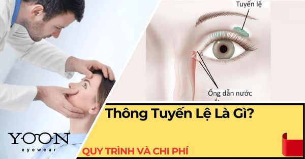Thông Tuyến Lệ Là Gì? Quy Trình, Chi Phí & Những Điều Cần Biết