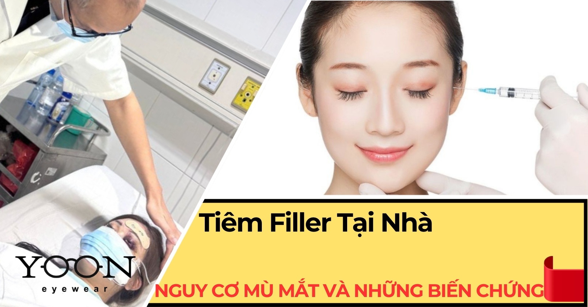 Tiêm Filler Tại Nhà: Nguy Cơ Mù Mắt Và Hàng Loạt Biến Chứng Không Ngờ