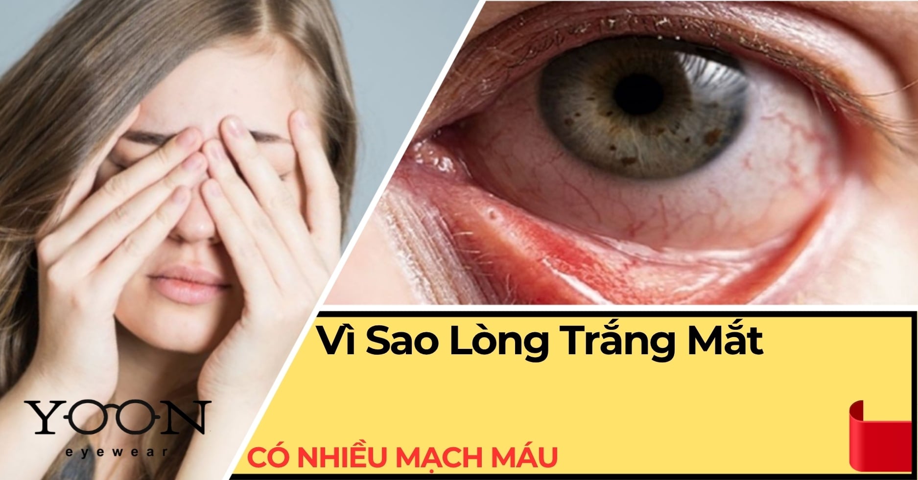 Vì Sao Lòng Trắng Mắt Có Nhiều Mạch Máu? Những Điều Cần Biết