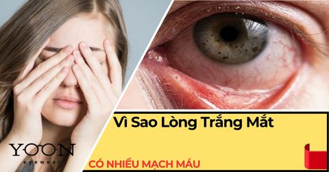 Vì Sao Lòng Trắng Mắt Có Nhiều Mạch Máu? Những Điều Cần Biết