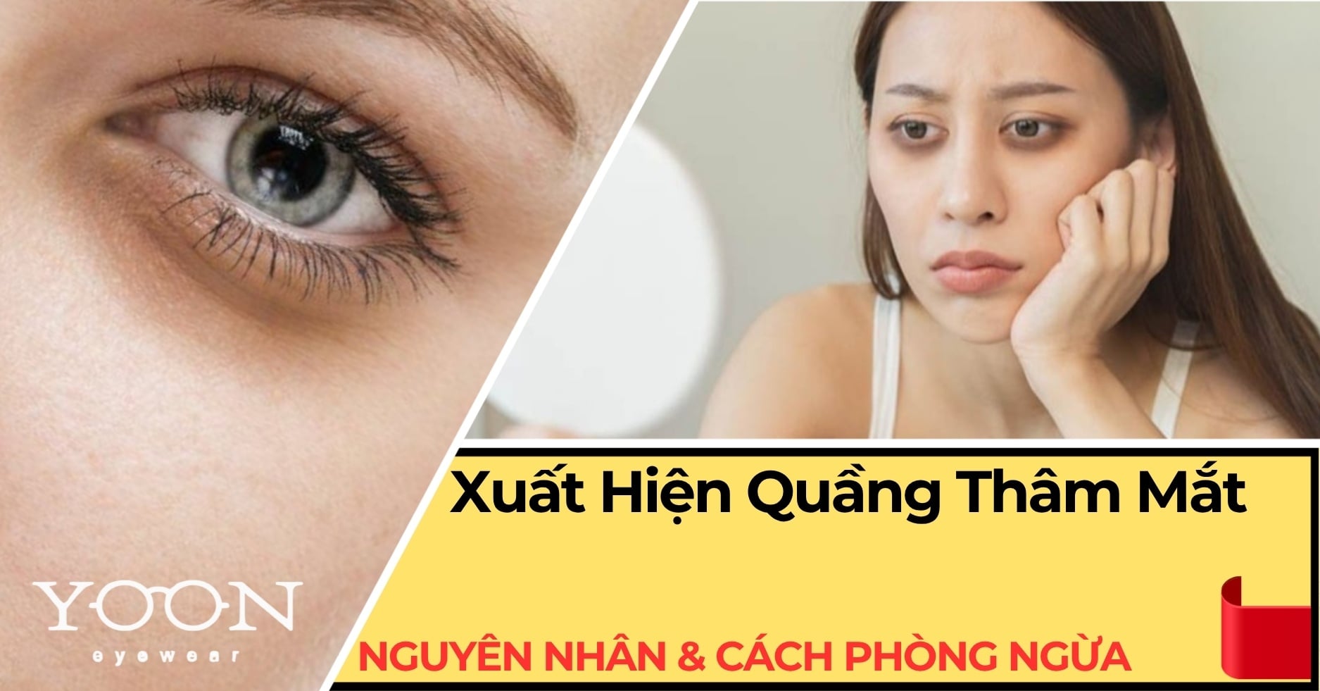 Vì Sao Xuất Hiện Quầng Thâm Mắt? Nguyên Nhân Và Cách Phòng Ngừa