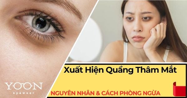 Vì Sao Xuất Hiện Quầng Thâm Mắt? Nguyên Nhân Và Cách Phòng Ngừa