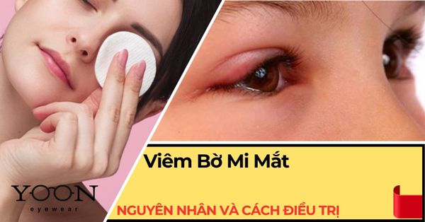 Viêm Bờ Mi Mắt: Nguyên Nhân, Triệu Chứng & Cách Điều Trị