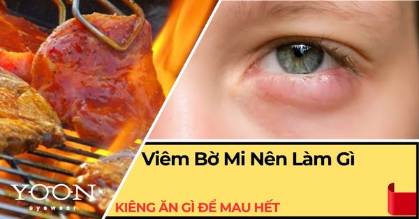 Viêm Bờ Mi Nên Làm Gì Và Kiêng Ăn Gì Để Mau Hết?