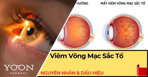 Viêm Võng Mạc Sắc Tố: Nguyên Nhân, Dấu Hiệu & Cách Điều Trị