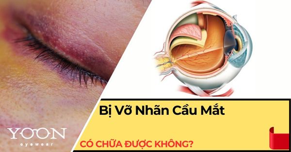 Vỡ Nhãn Cầu Mắt Có Chữa Được Không? Cách Điều Trị & Tiên Lượng