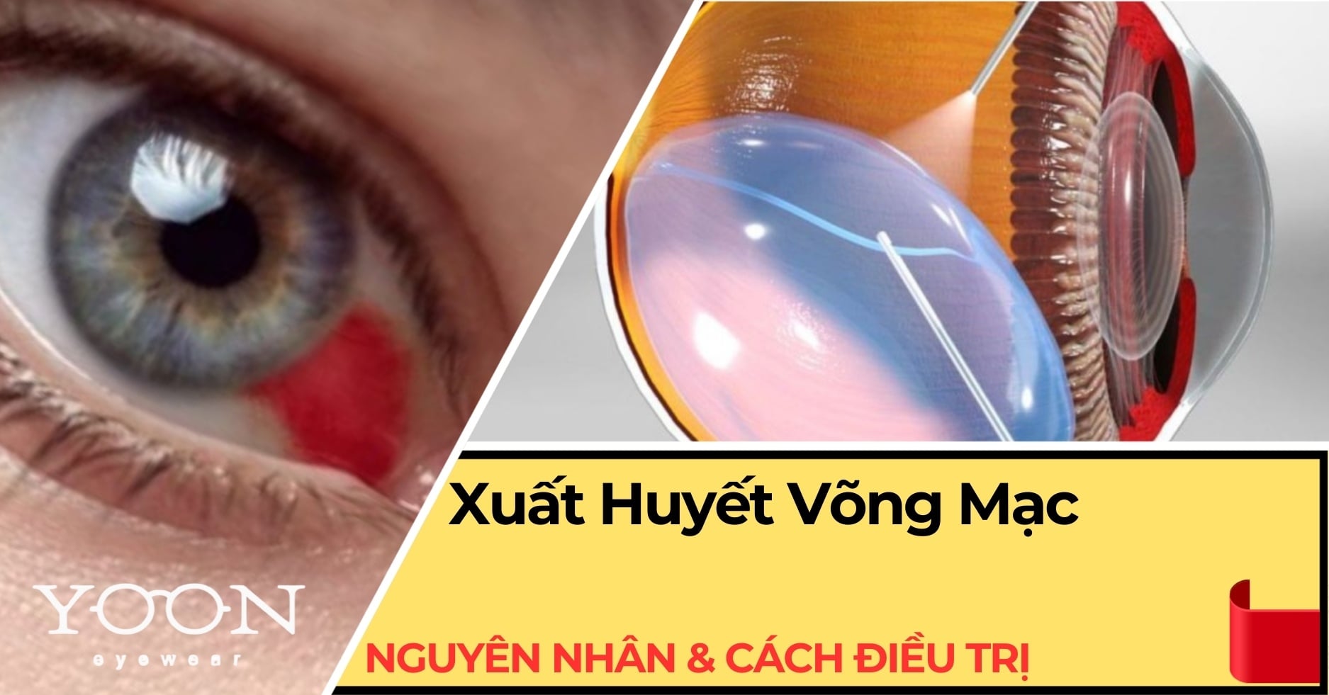 Xuất Huyết Võng Mạc: Nguyên Nhân, Triệu Chứng & Cách Điều Trị