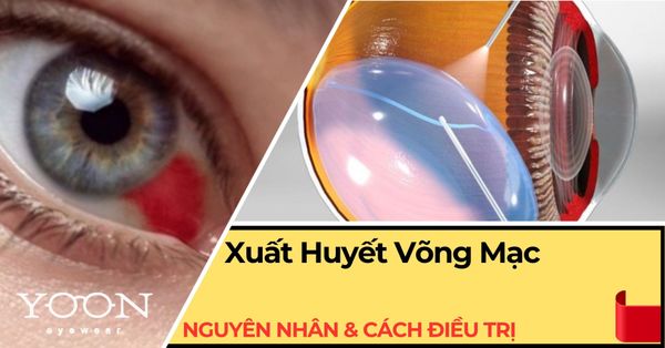 Xuất Huyết Võng Mạc: Nguyên Nhân, Triệu Chứng & Cách Điều Trị