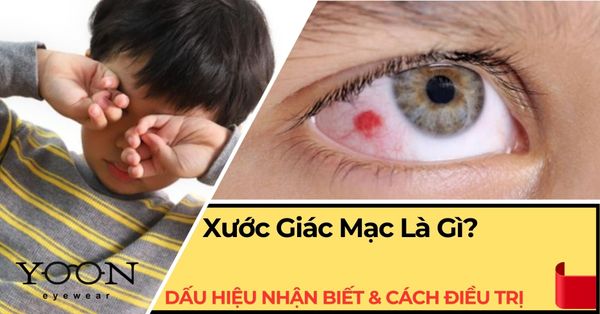 Xước Giác Mạc Là Gì? Dấu Hiệu Nhận Biết & Cách Điều Trị