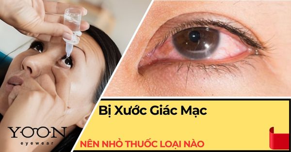 Xước Giác Mạc Nên Nhỏ Thuốc Gì? Đừng Dùng Sai Cách